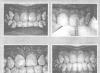 Некариозные поражения, возникающие до прорезывания зубов
